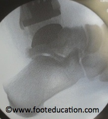 Ankle-Replacement_Figure-6
